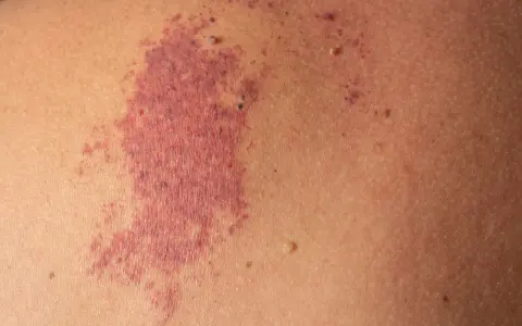 Macchia rossastra sulla pelle, simile a un morso della cicogna adulto, con piccole protuberanze.