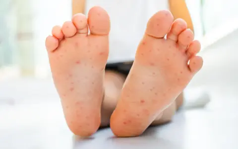 Piedi di bambino con eruzione cutanea, possibile contagio mani bocca. I genitori preoccupati cercano risposte.