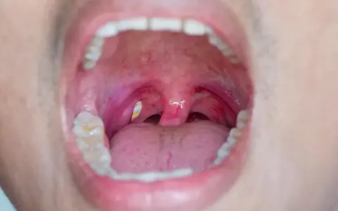 Gola infiammata con tonsille rosse e gonfie, dove si notano evidenti calcoli tonsillari giallastri.