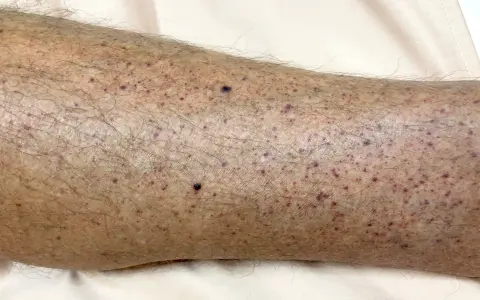 Gambe con numerosi puntini rossi e qualche neo scuro, senza segni di prurito.