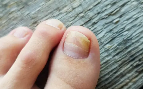 Dito unghia del piede con micosi. Si cercano rimedi naturali efficaci per combattere questo fastidioso problema.