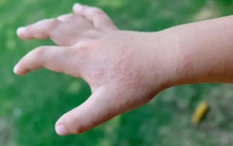 Mano di bambino con puntini rossi sulle dita e sul dorso, senza segni di prurito.