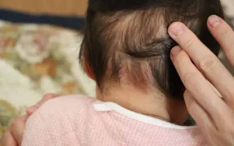 Dita accarezzano la nuca di un neonato, dove si notano delle piccole macchie rosse, un segno del "morso della cicogna".
