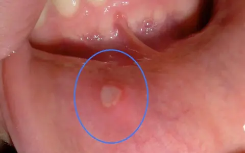 Una piccola afte, simile a bolle sulle labbra, circondata da un alone rosso, visibile all'interno della bocca.