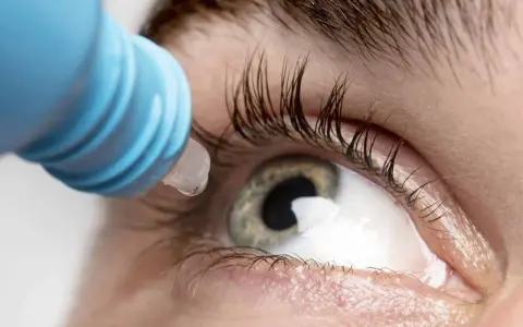 Goccia di collirio antibiotico cade sull'occhio, alleviando un'infezione.