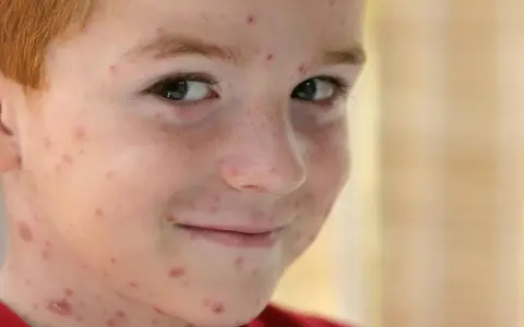 Primo giorno di varicella per questo bimbo con i capelli rossi, il viso e il collo coperti di bolle rosse.
