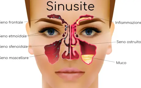 Illustrazione anatomica della sinusite, con seni frontali, etmoidali, sfenoidali e mascellari infiammati e ostruiti da muco. Utile per capire i rimedi.