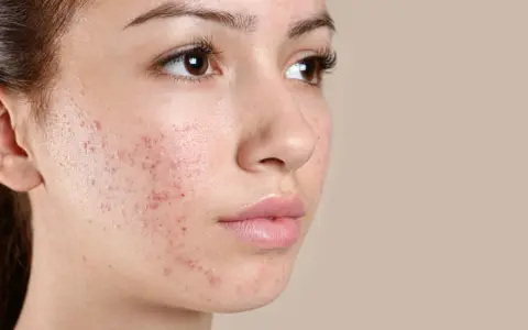 Primo piano del volto di una giovane donna con evidenti brufoli e punti neri sulla guancia.