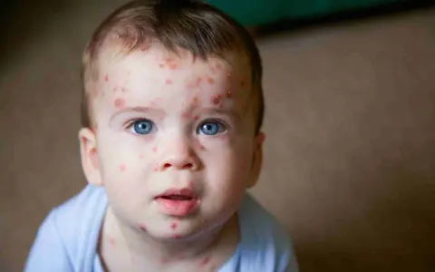 Bambino con eruzioni cutanee tipiche della quinta malattia. La cura è solitamente sintomatica, ma è bene consultare un medico.