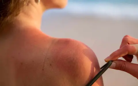 Spalla arrossata dal sole, un tentativo di come abbronzarsi velocemente, ma attenzione alle scottature!
