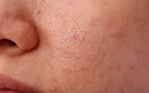 Primo piano della pelle con pori dilatati e alcuni punti neri visibili, che creano una texture irregolare.