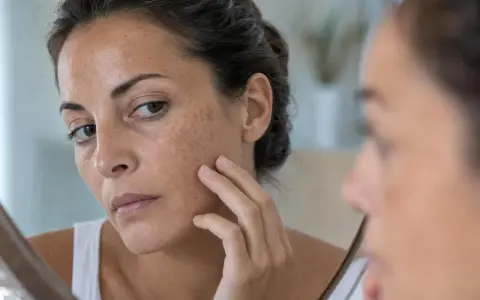 Donna si guarda allo specchio, toccandosi il viso dove compaiono macchie scure sulla pelle.
