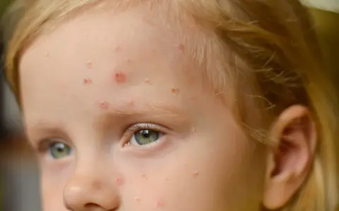 Viso di bambina con eruzioni cutanee, possibili segni di orticaria da streptococco nei bambini.