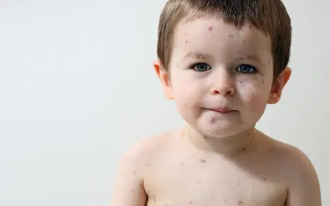 Bambino con puntini rossi sul viso e sul corpo, forse la varicella.