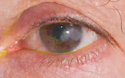 Occhio con segni di herpes, arrossamento e secrezioni giallastre. La cornea presenta un'area opaca e verdeggiante.