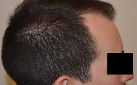 Profilo di un uomo con diradamento dei capelli nella zona della corona, indicativo di alopecia androgenetica.