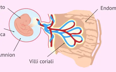 Feto nella cavità amniotica, collegato ai villi coriali nell'endometrio. Il sacco vitellino senza embrione è visibile.