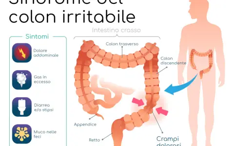 Sintomi del colon irritabile: dolore addominale, gas, diarrea/stipsi e muco. Il colon è evidenziato in un corpo umano.