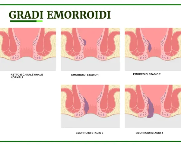 Illustrazione dei gradi di emorroidi, da normali a stadio 4. Capire quando preoccuparsi è fondamentale.