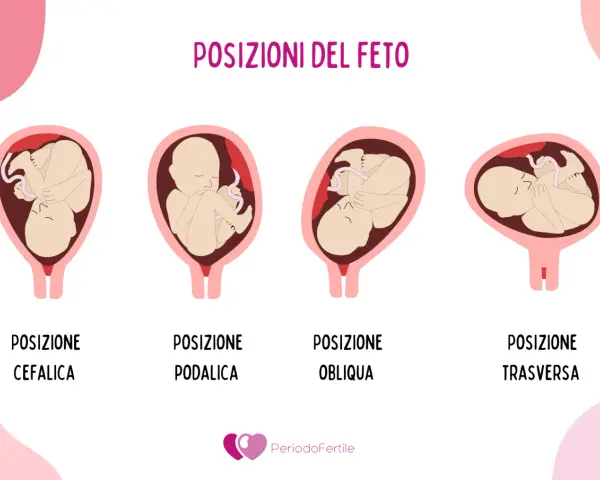 Illustrazione mostra le posizioni del feto: cefalica, podalica, obliqua e trasversa. La posizione podalica è quella in cui il bambino è seduto, con i piedi verso il basso.