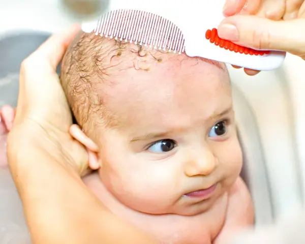 Mani delicate rimuovono la crosta lattea dal cuoio capelluto di un neonato con un pettinino bianco e rosso.