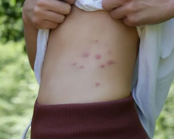 Punture di acari rosse e pruriginose sul fianco di una persona, con sfondo verde sfocato.