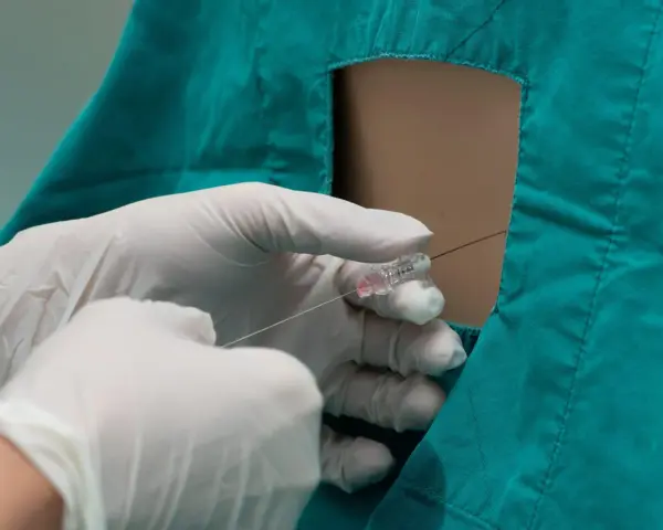 Mani guantate eseguono un'iniezione epidurale, sollevando interrogativi sugli epidurale effetti collaterali a lungo termine.