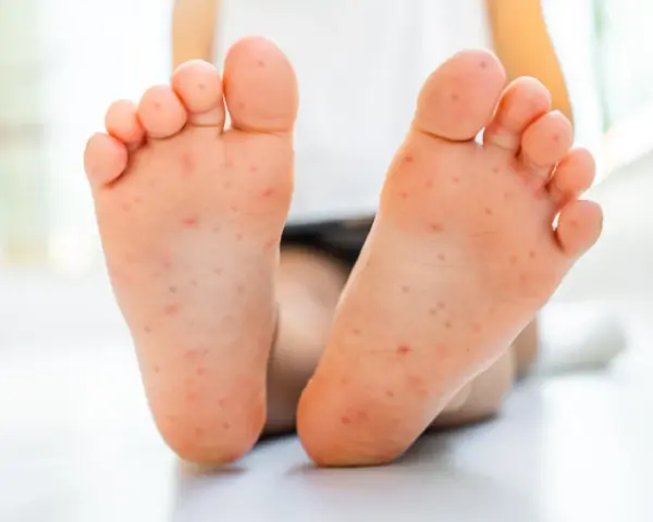 Piedi di bambino con eruzione cutanea, possibile contagio mani bocca. I genitori preoccupati cercano risposte.