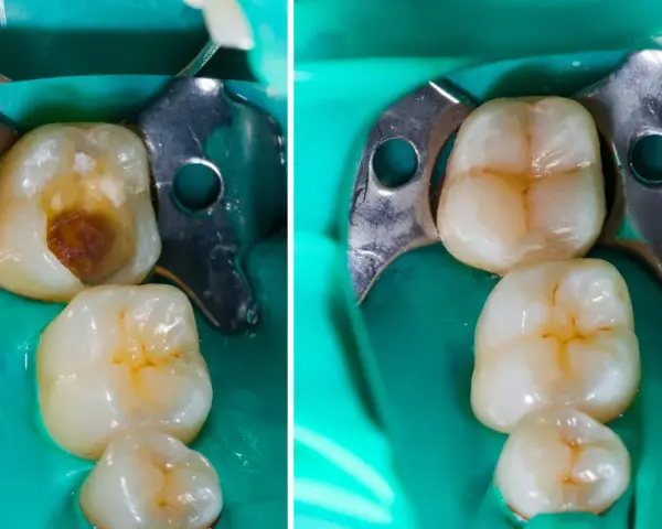 Prima e dopo: un dente con carie profonda e il suo ripristino con otturazione estetica.