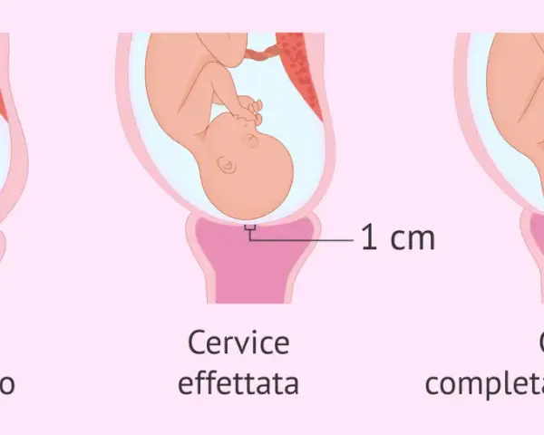 Illustrazione del nono mese di gravidanza: utero con feto, cervice non dilatata, dilatata 1 cm e completamente dilatata (10 cm).