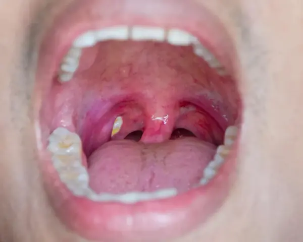 Gola infiammata con tonsille rosse e gonfie, dove si notano evidenti calcoli tonsillari giallastri.