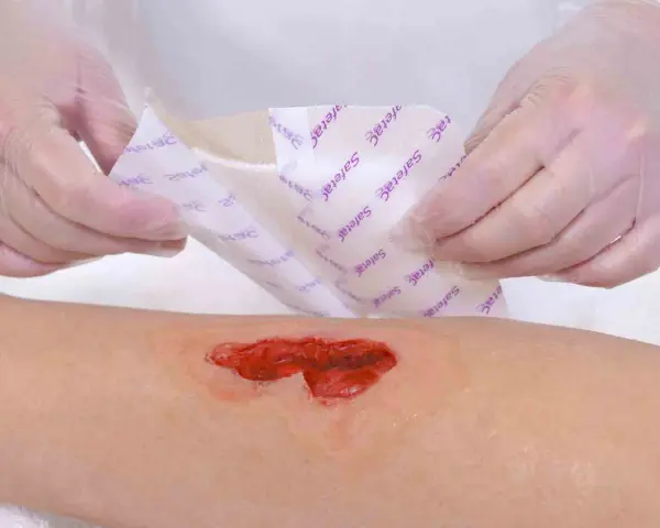 Mani guantate applicano una medicazione su una ferita aperta, un passo importante per imparare come cicatrizzare una ferita velocemente.