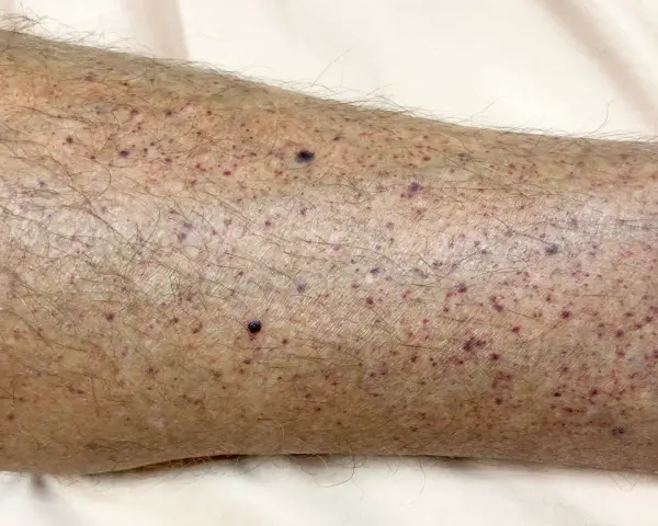 Gambe con numerosi puntini rossi e qualche neo scuro, senza segni di prurito.