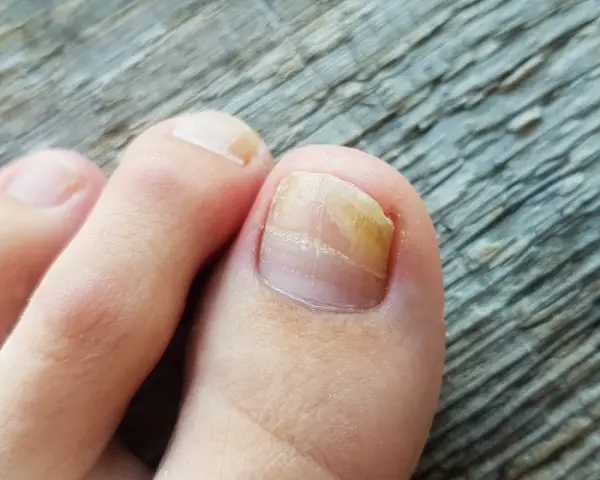 Dito unghia del piede con micosi. Si cercano rimedi naturali efficaci per combattere questo fastidioso problema.