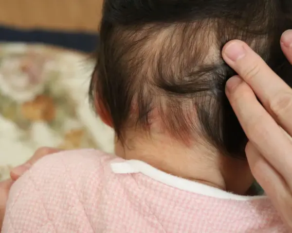 Dita accarezzano la nuca di un neonato, dove si notano delle piccole macchie rosse, un segno del "morso della cicogna".