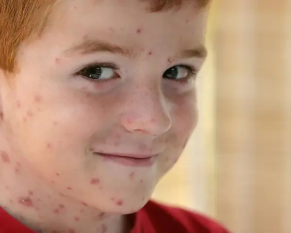Primo giorno di varicella per questo bimbo con i capelli rossi, il viso e il collo coperti di bolle rosse.