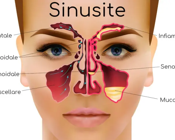 Illustrazione anatomica della sinusite, con seni frontali, etmoidali, sfenoidali e mascellari infiammati e ostruiti da muco. Utile per capire i rimedi.