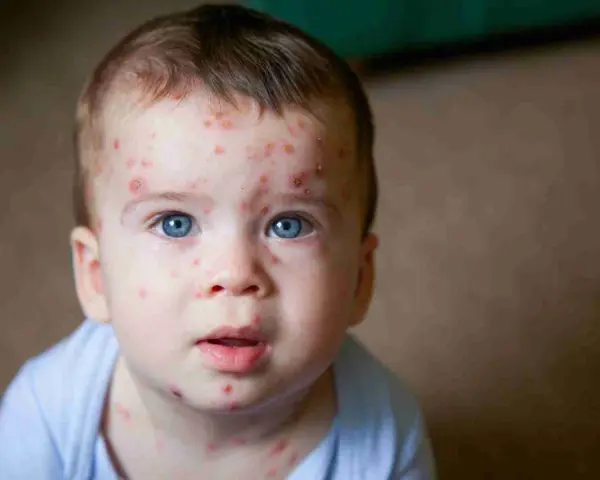 Bambino con eruzioni cutanee tipiche della quinta malattia. La cura è solitamente sintomatica, ma è bene consultare un medico.