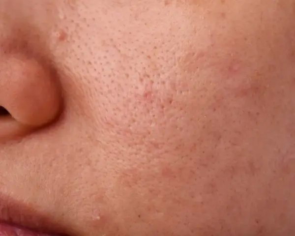 Primo piano della pelle con pori dilatati e alcuni punti neri visibili, che creano una texture irregolare.
