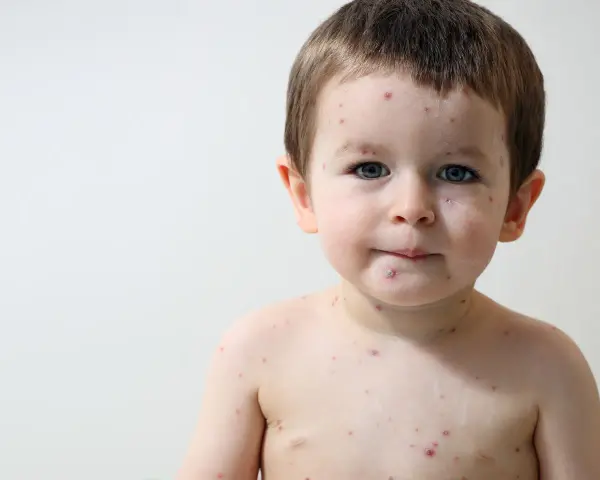 Bambino con puntini rossi sul viso e sul corpo, forse la varicella.
