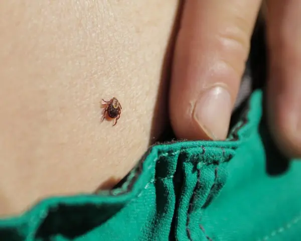 Una zecca è attaccata alla pelle, vicino a un lembo di tessuto verde. La puntura di zecca è un rischio da non sottovalutare.