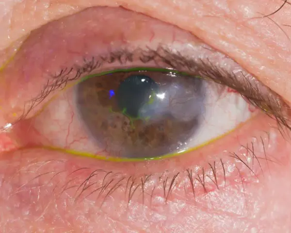 Occhio con segni di herpes, arrossamento e secrezioni giallastre. La cornea presenta un'area opaca e verdeggiante.