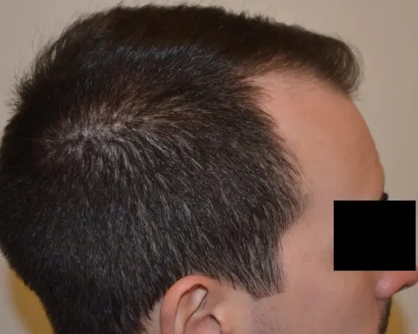 Profilo di un uomo con diradamento dei capelli nella zona della corona, indicativo di alopecia androgenetica.