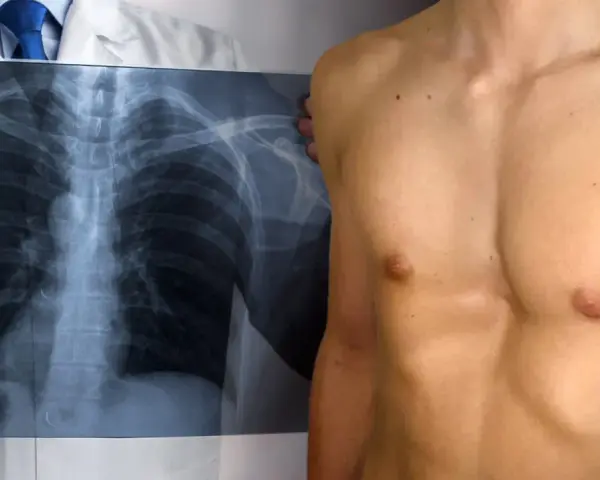 Medico mostra radiografia torace, evidenziando un petto a imbuto.