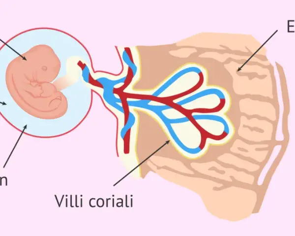Feto nella cavità amniotica, collegato ai villi coriali nell'endometrio. Il sacco vitellino senza embrione è visibile.