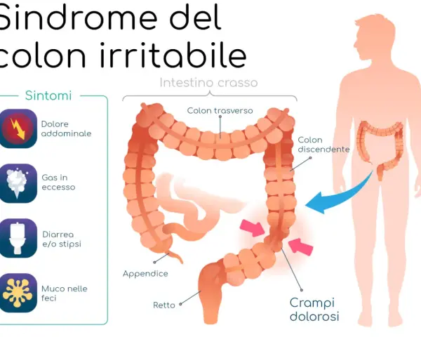 Sintomi del colon irritabile: dolore addominale, gas, diarrea/stipsi e muco. Il colon è evidenziato in un corpo umano.