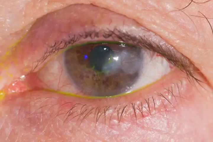 Occhio con segni di herpes, arrossamento e secrezioni giallastre. La cornea presenta un'area opaca e verdeggiante.
