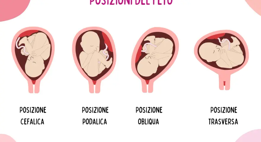 Illustrazione mostra le posizioni del feto: cefalica, podalica, obliqua e trasversa. La posizione podalica è quella in cui il bambino è seduto, con i piedi verso il basso.