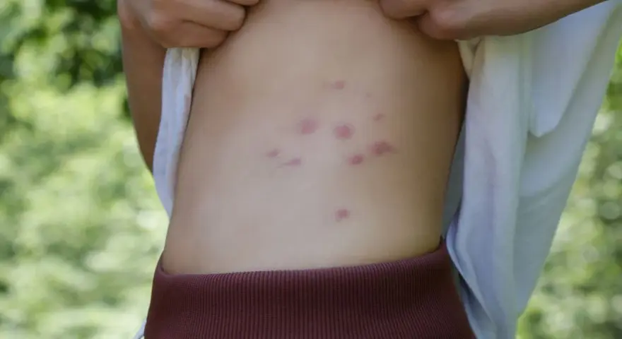 Punture di acari rosse e pruriginose sul fianco di una persona, con sfondo verde sfocato.