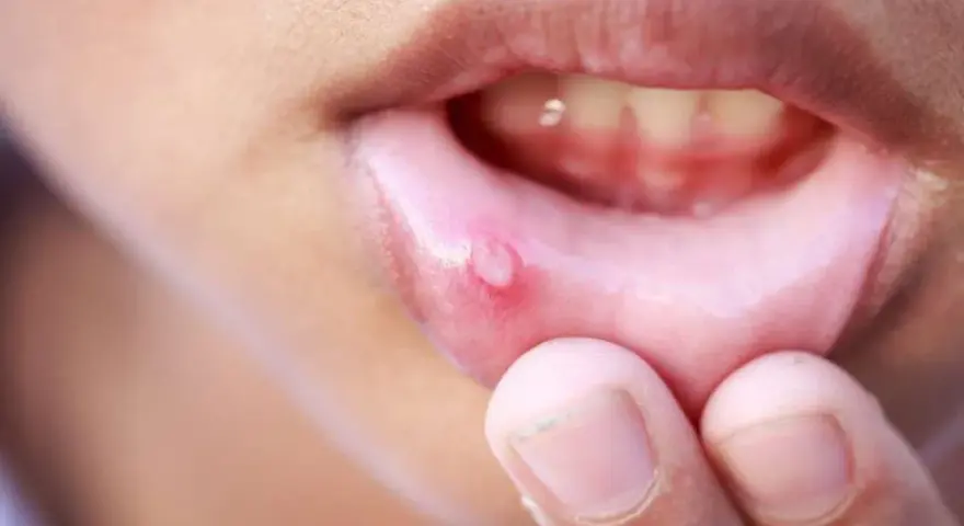 Dito si vede una stomatite aftosa, un'ulcera dolorosa sul labbro interno, che causa disagio.